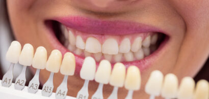 Transform Your Smile with Veneers at The Smile Bar Camps Bay
